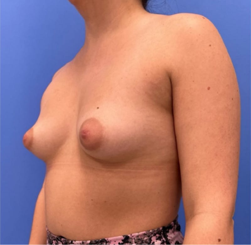 Breast Augmentation Before & After Gallery - Patient 351838 - Image 4
