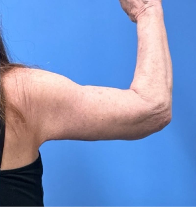 Brachioplasty Before & After Gallery - Patient 394215 - Image 4