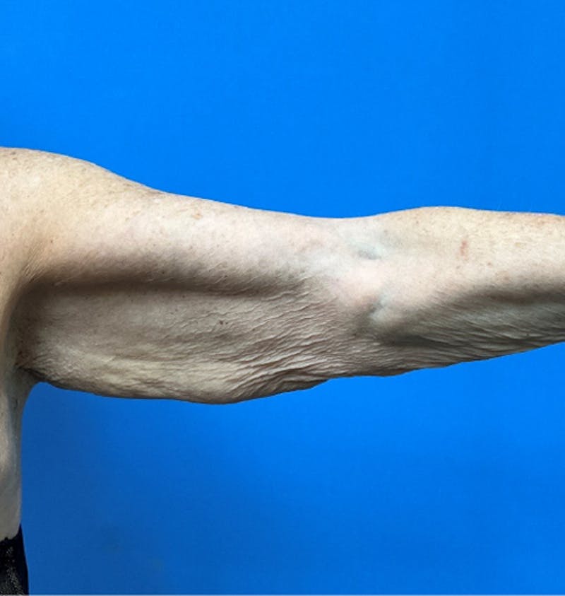 Brachioplasty Before & After Gallery - Patient 394215 - Image 5