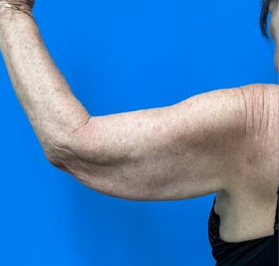 Brachioplasty Before & After Gallery - Patient 394215 - Image 1