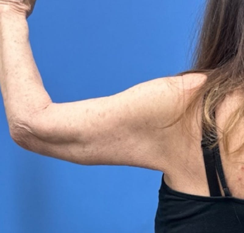Brachioplasty Before & After Gallery - Patient 394215 - Image 2