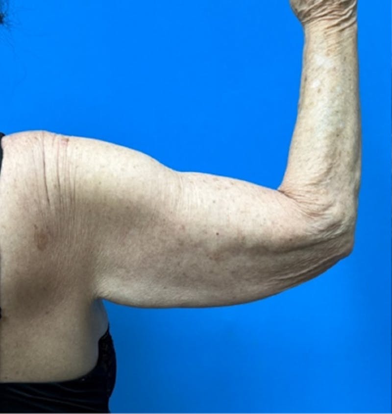 Brachioplasty Before & After Gallery - Patient 394215 - Image 3