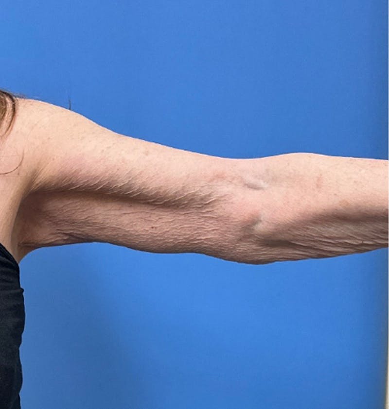 Brachioplasty Before & After Gallery - Patient 394215 - Image 6