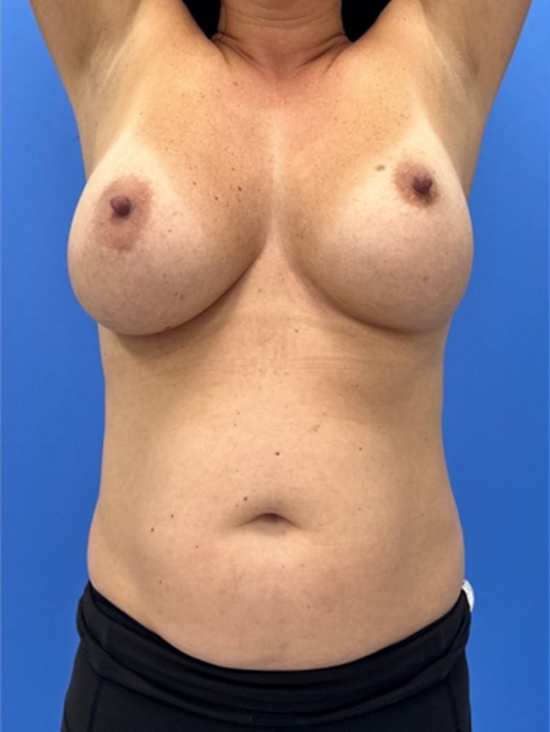 Liposuction Before & After Gallery - Patient 281520 - Image 3