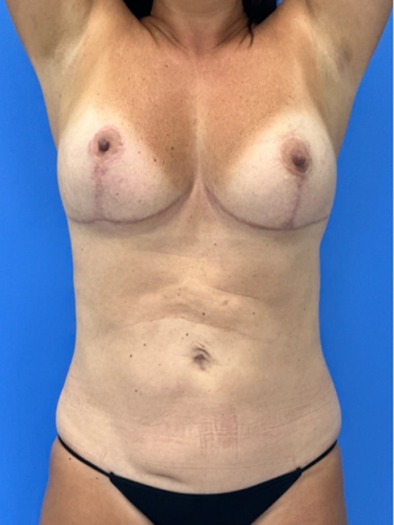 Liposuction Before & After Gallery - Patient 281520 - Image 4