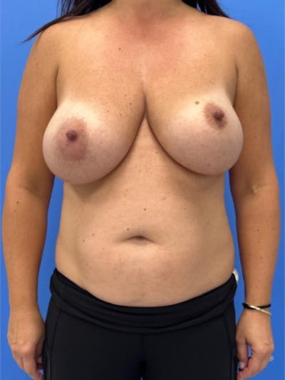 Breast Reduction Before & After Gallery - Patient 142380 - Image 1