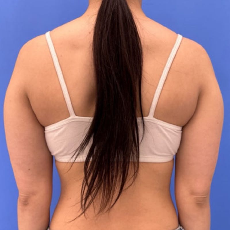 Liposuction Before & After Gallery - Patient 291918 - Image 6