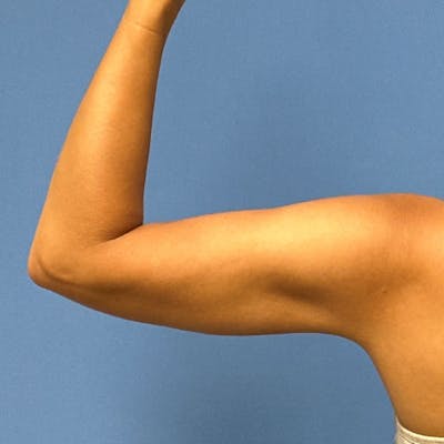 Liposuction Before & After Gallery - Patient 291918 - Image 1