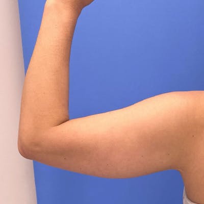 Liposuction Before & After Gallery - Patient 291918 - Image 2