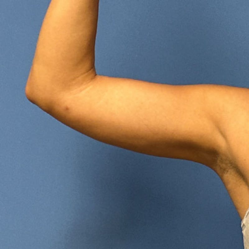 Liposuction Before & After Gallery - Patient 291918 - Image 3