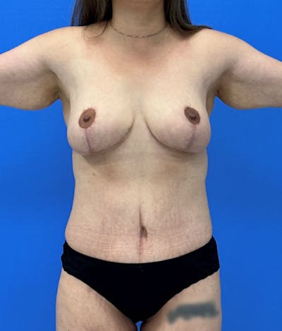 Abdominoplasty Before & After Gallery - Patient 344390 - Image 2