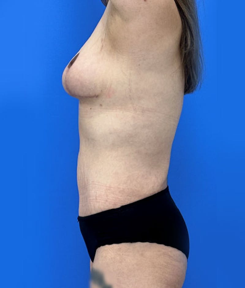 Liposuction Before & After Gallery - Patient 169476 - Image 6