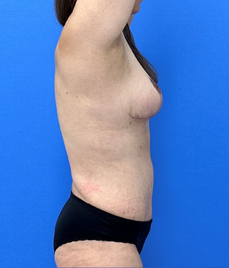 Liposuction Before & After Gallery - Patient 169476 - Image 4