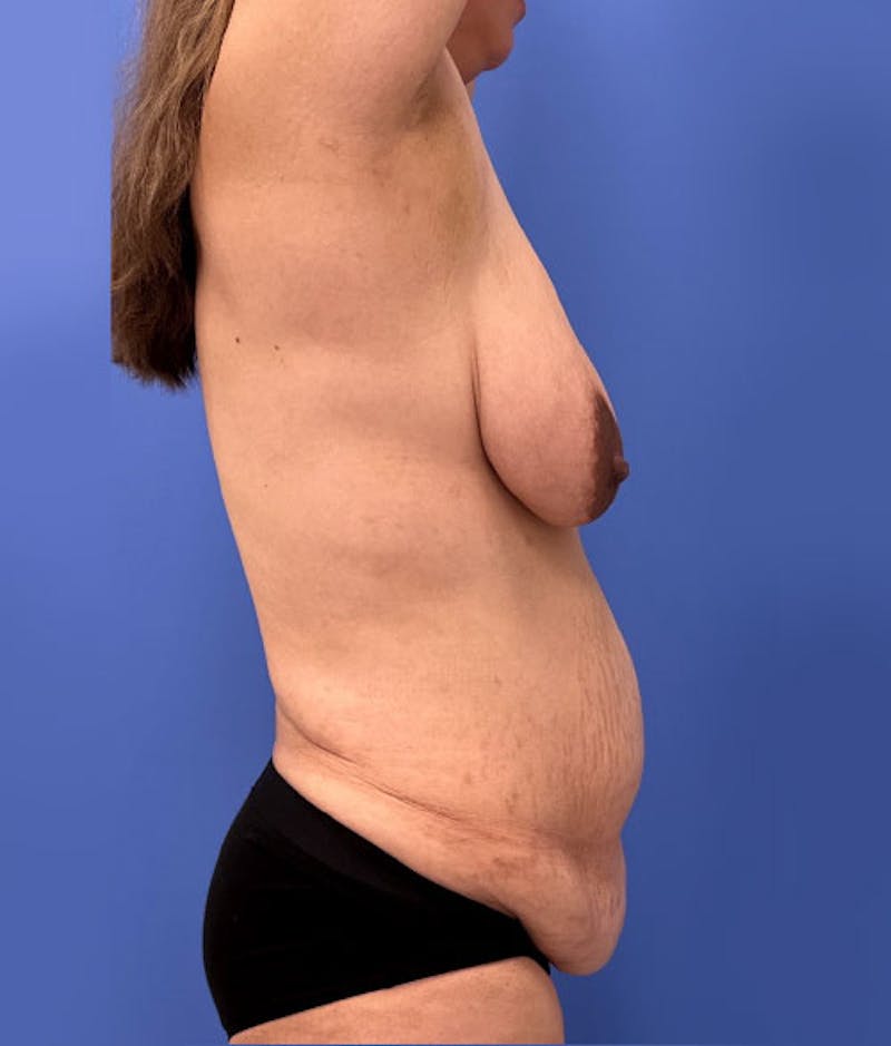 Liposuction Before & After Gallery - Patient 169476 - Image 3
