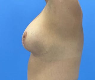Breast Augmentation Before & After Gallery - Patient 575593 - Image 8