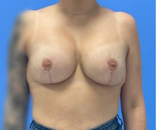 Breast Augmentation Before & After Gallery - Patient 575593 - Image 2