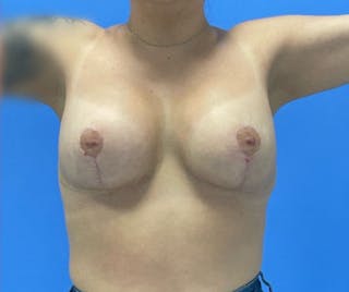 Breast Augmentation Before & After Gallery - Patient 575593 - Image 4