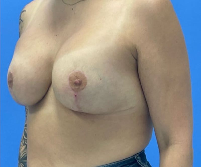 Breast Augmentation Before & After Gallery - Patient 575593 - Image 6