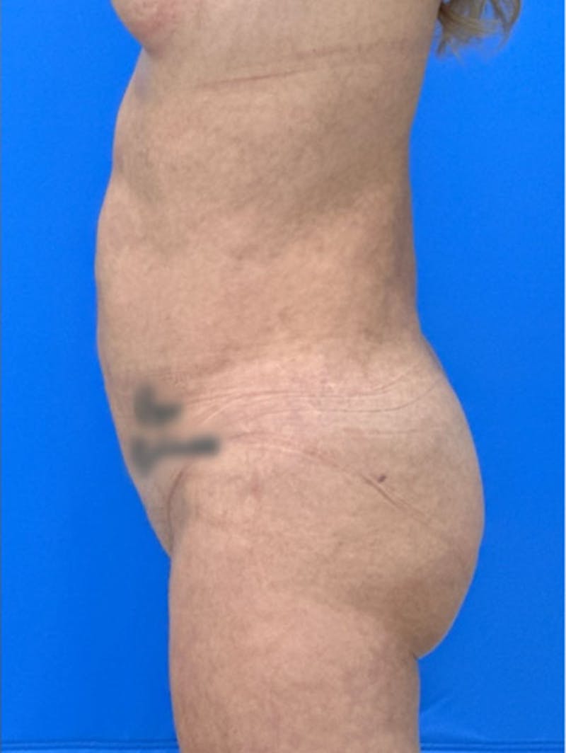 Brazilian Butt Lift Before & After Gallery - Patient 268282 - Image 6
