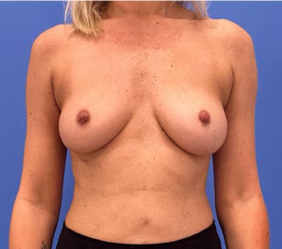 Breast Augmentation Before & After Gallery - Patient 244454 - Image 2