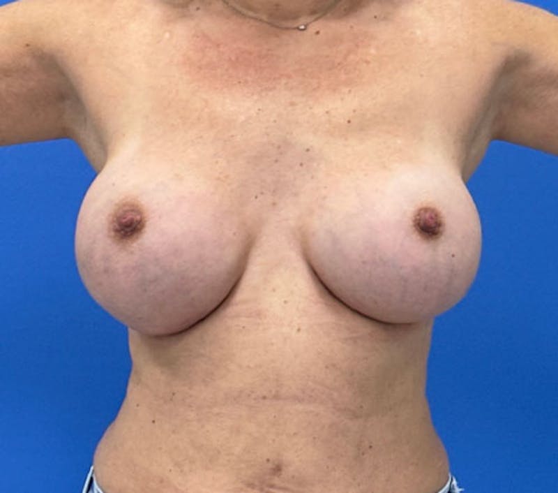Breast Augmentation Before & After Gallery - Patient 244454 - Image 3