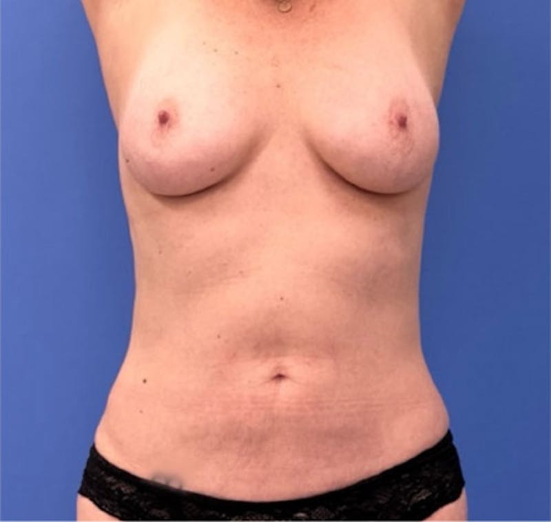 Liposuction Before & After Gallery - Patient 405344 - Image 4