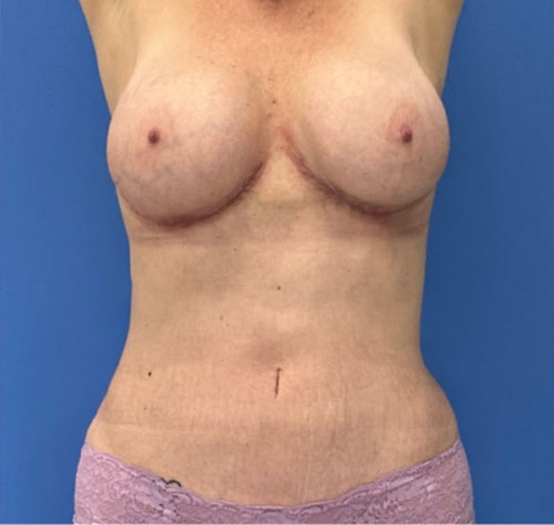 Liposuction Before & After Gallery - Patient 405344 - Image 3
