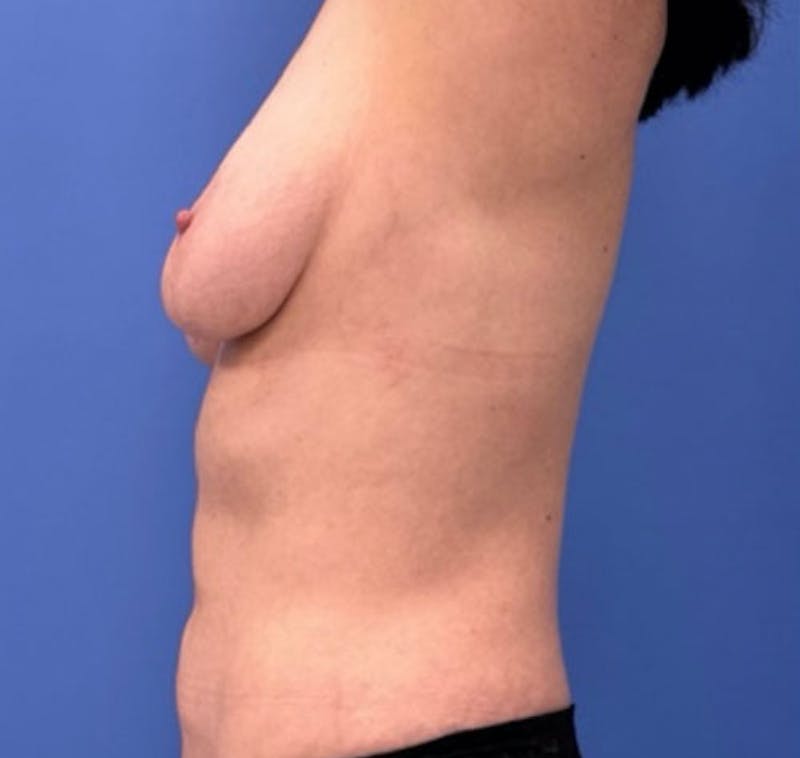 Liposuction Before & After Gallery - Patient 405344 - Image 8
