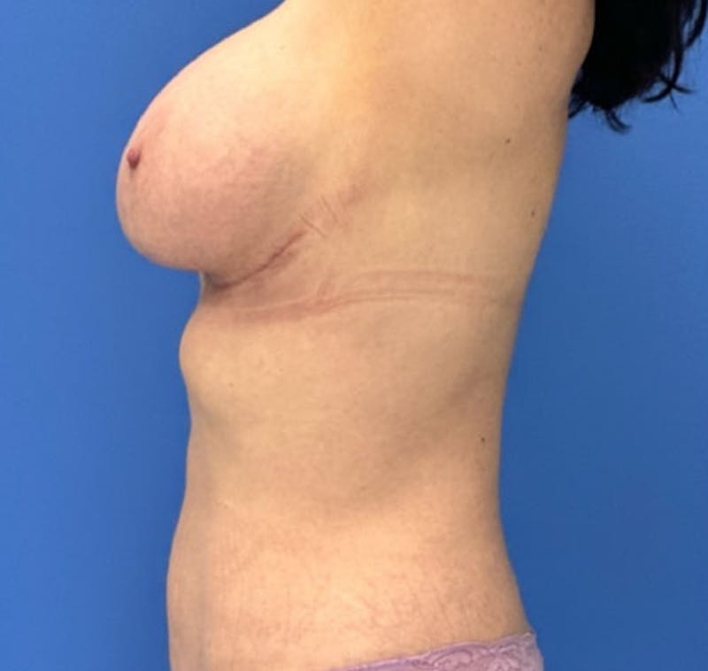 Liposuction Before & After Gallery - Patient 405344 - Image 7