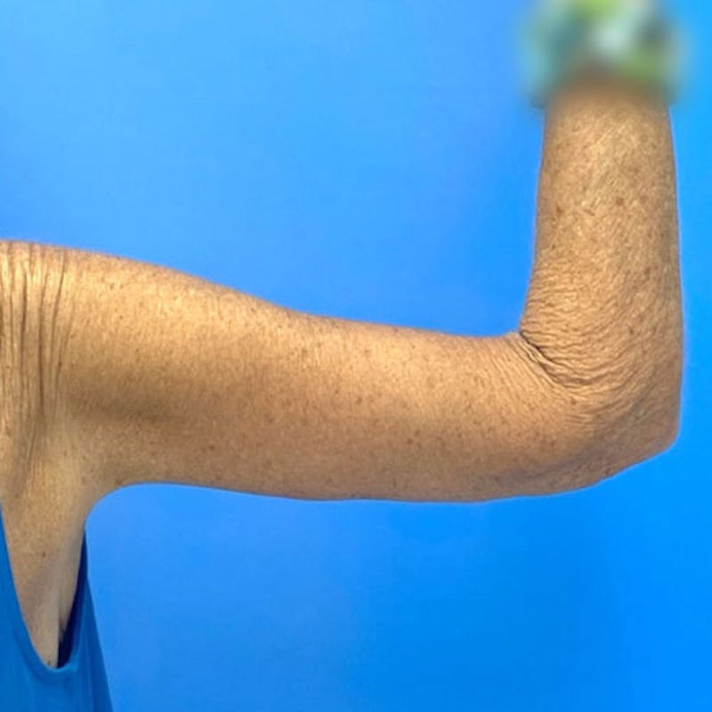 Brachioplasty Before & After Gallery - Patient 349841 - Image 4