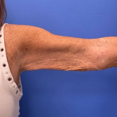 Brachioplasty Before & After Gallery - Patient 349841 - Image 1