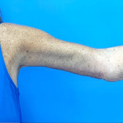 Brachioplasty Before & After Gallery - Patient 349841 - Image 2