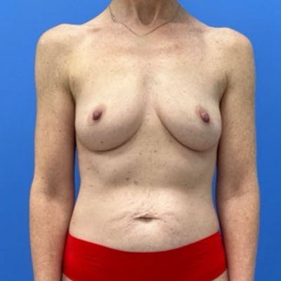 Breast Augmentation Before & After Gallery - Patient 333558 - Image 1