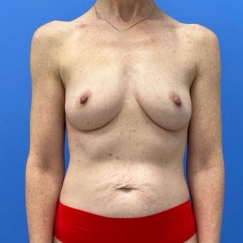Abdominoplasty Before & After Gallery - Patient 657589 - Image 1
