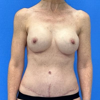 Breast Augmentation Before & After Gallery - Patient 333558 - Image 2