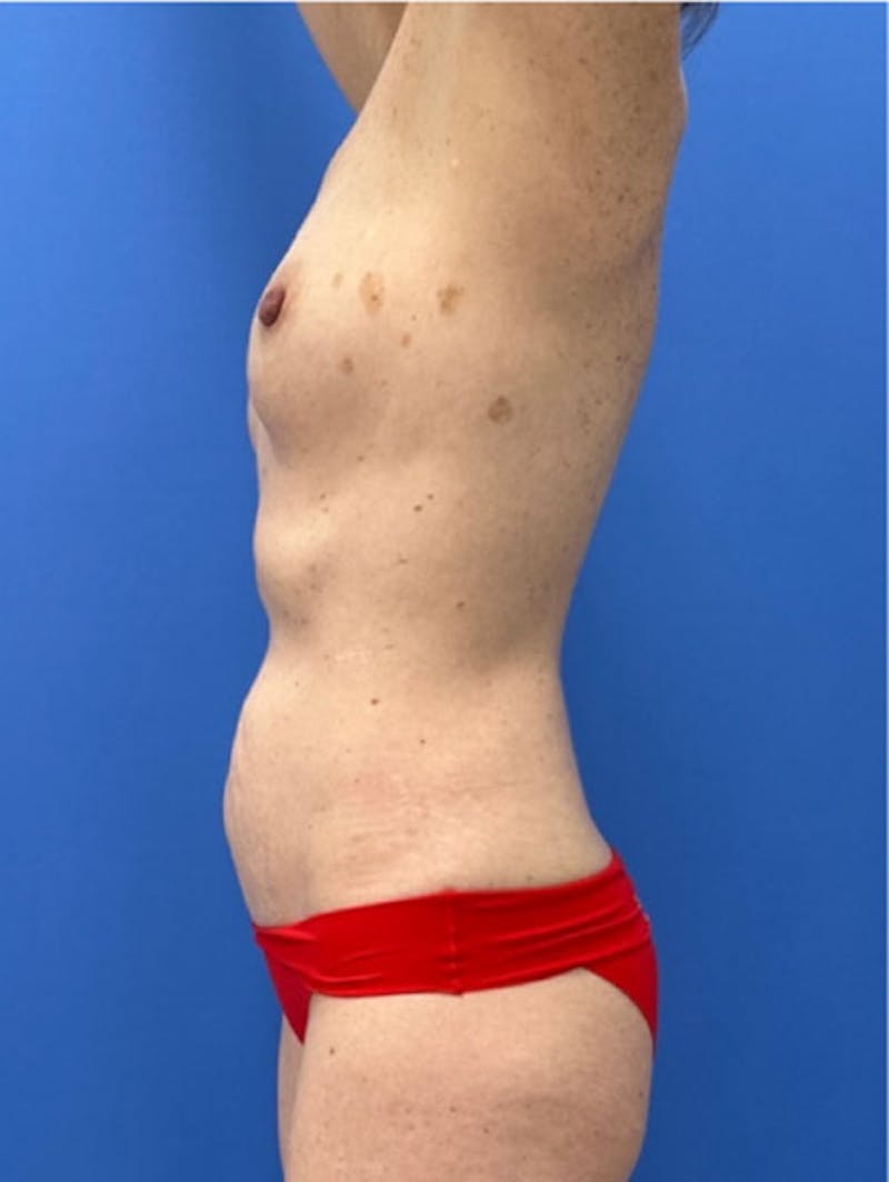 Abdominoplasty Before & After Gallery - Patient 657589 - Image 3