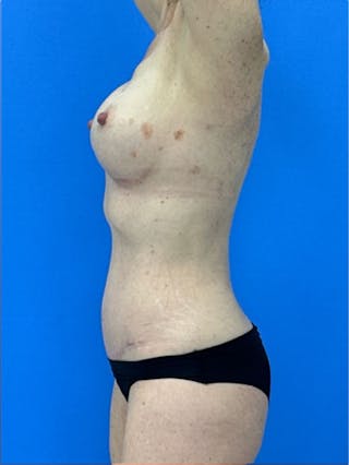 Breast Augmentation Before & After Gallery - Patient 333558 - Image 4