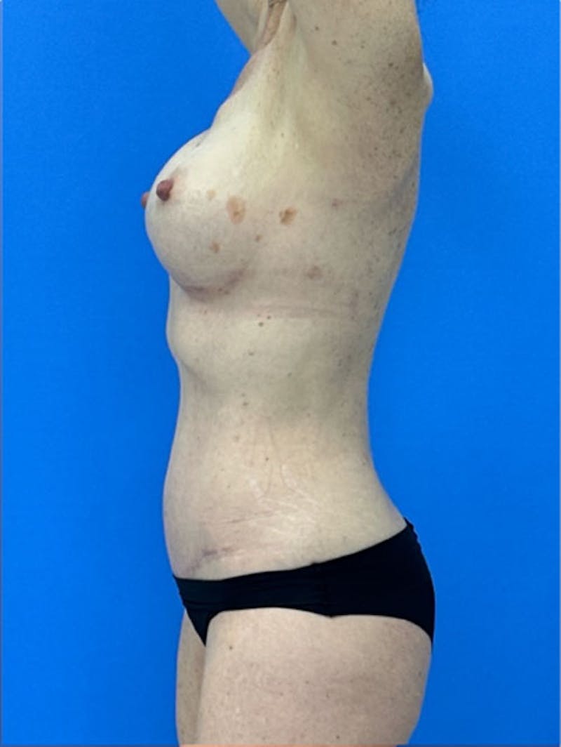 Abdominoplasty Before & After Gallery - Patient 657589 - Image 4