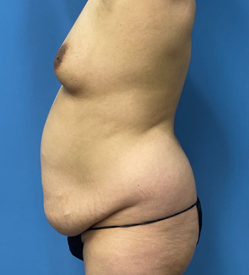 Breast Augmentation Before & After Gallery - Patient 418598 - Image 3