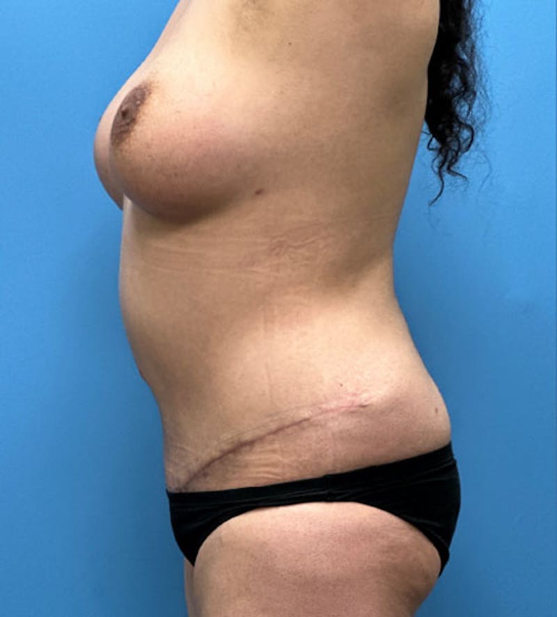 Breast Augmentation Before & After Gallery - Patient 418598 - Image 4