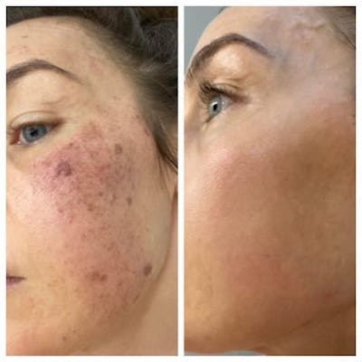IPL Before & After Gallery - Patient 424031 - Image 1