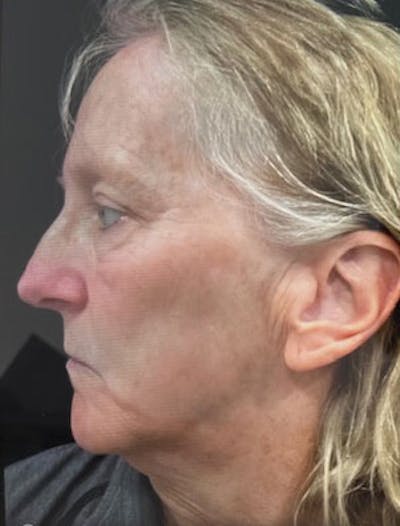 IPL Before & After Gallery - Patient 118099 - Image 1