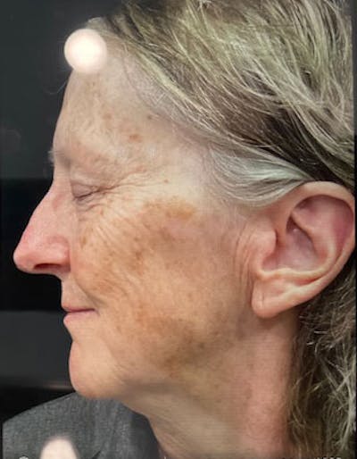 IPL Before & After Gallery - Patient 118099 - Image 2