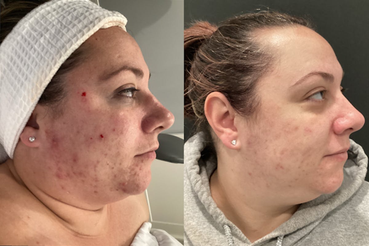 Chemical Peel Before & After Gallery - Patient 144150 - Image 1
