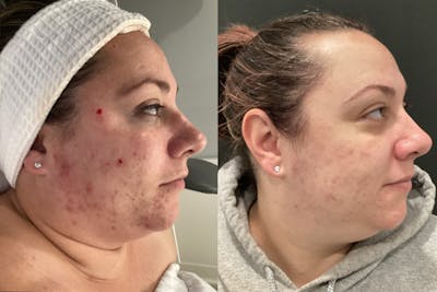 Chemical Peel Before & After Gallery - Patient 144150 - Image 1