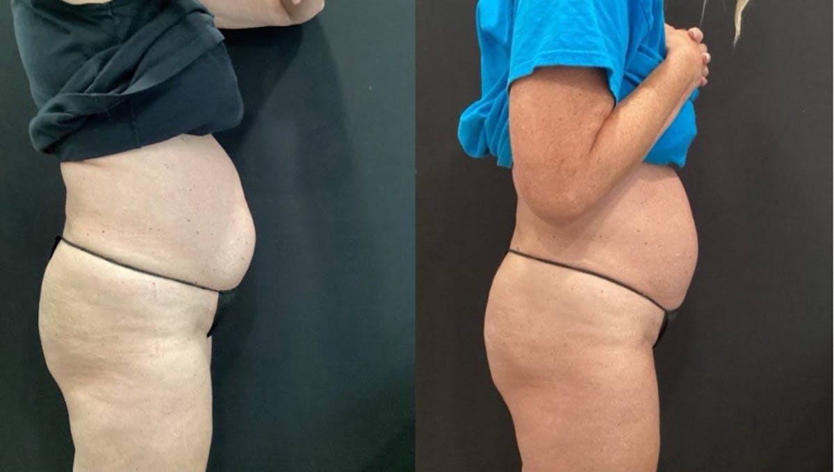 Coolsculpting Before & After Gallery - Patient 168042 - Image 1