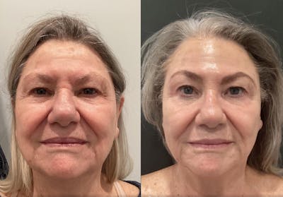 Microneedling Before & After Gallery - Patient 146558 - Image 1