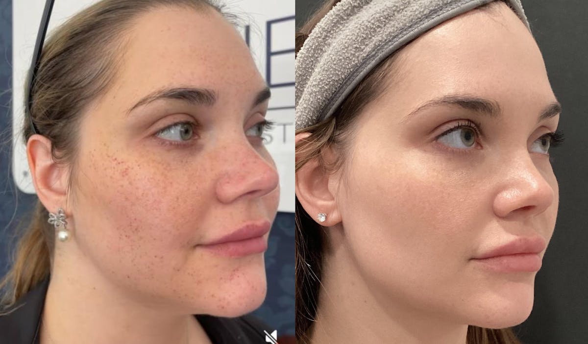 Illumilift Before & After Gallery - Patient 138360 - Image 2
