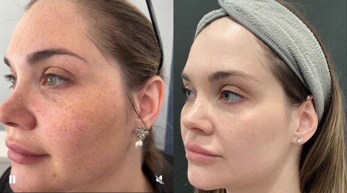 Illumilift Before & After Gallery - Patient 138360 - Image 1