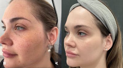 Illumilift Before & After Gallery - Patient 138360 - Image 1
